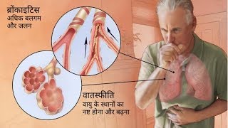 Asthacare Respules Review How To Get Relief From COPD amp Asthma [upl. by Gnak600]