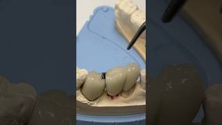 PFM Keyway Attachment lsk121shorts dentist teeth [upl. by Atilemrac]