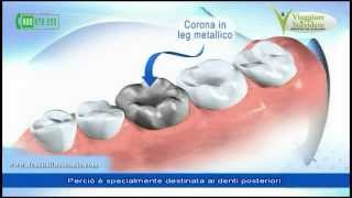 Le Corone Dentali le Capsule e i Denti in Ceramica metallo o zirconio [upl. by Otis]