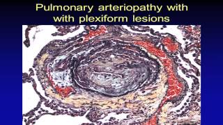 Pulmonary Hypertension Pathology [upl. by Eran]