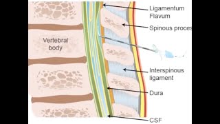 Thoracic epidural anesthesia [upl. by Bartel]