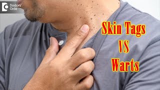 What Causes Skin Tags And Warts  Get Rid of Warts amp Skin Tags Dr Renuka Shetty  Doctors Circle [upl. by Ehcropal]