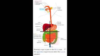 Rovsings Sign acute appendicitis McBurneys Signappendicitis amp McBurneys Point [upl. by Altman]