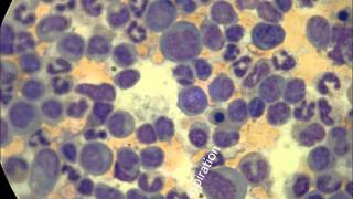 Juvenile Myelomonocytic leukemia 3 patients [upl. by Rodrigo]