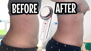 Ultrasonic Fat Cavitation Before And After  Fat Cavitation Before And After Results  AMAZING [upl. by Henni185]