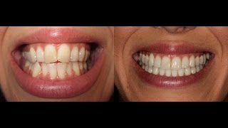 Invisalign Time Lapse UPDATED [upl. by Dibrin]