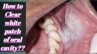 How to Clear White patch of mouth How to cure leukoplakia How to cure our white patch of mouth [upl. by Afas]