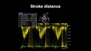 Echocardiography Essentials Spotting tricuspid and pulmonary valve disease [upl. by Eigla582]