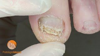 Deep cleaning of thick nails with fungus podologiaintegral [upl. by Clarke]