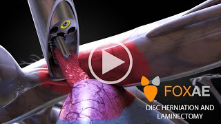 Laminectomy  Legal Animation  Surgery Demonstration [upl. by Rats75]