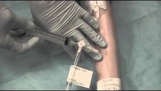 Catheter Patency and Management Clearance of a Thrombotic Occlusion [upl. by Eahs]