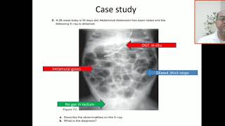 Case 83 necrotising enterocolitis NEC Bell criteria pneumatosis intestinalis pneumoperitoneum [upl. by Anet]