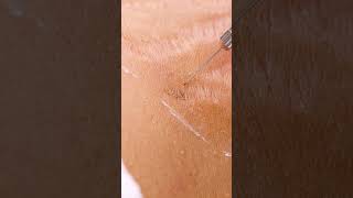 Up close view of how laser stretch mark removal works 😯 shorts [upl. by Ientirb]