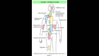 Virchows Node Abdominal Metastasis [upl. by Heath]