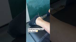 Needling Lower Back Pain Away [upl. by Yanrahs]