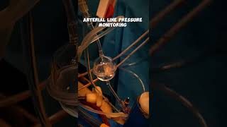 Arterial line Pressure Monitoring during Cardiac Surgery 🫀 heart trending video viralvideo [upl. by Assej931]