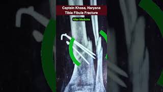 Tibia Fibula Recovery  Captain Khasa  Haryana  tibiafibulafracture [upl. by Muscolo]