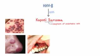 HHV8 and Kaposi Sarcoma [upl. by Leonidas156]