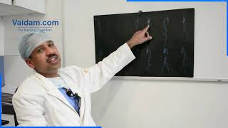 Bentall Procedure  Best Explained by Dr Sanjeev Kumar Singla of Medanta Hospital Gurgaon [upl. by Yuk]