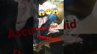 Ascitic Fluids removed process [upl. by Constancia289]