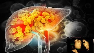 Cirrhosis of Liver Full Details liverdetox liverhealth cirrhosis diseasecure treatment [upl. by Adnomar903]