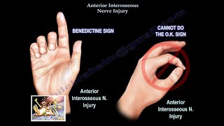 Anterior Interosseous Nerve Injury  Everything You Need To Know  Dr Nabil Ebraheim [upl. by Ayotal]