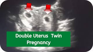 Double Uterus Twin Pregnancy  bicornuate  67 weeks [upl. by Farmann642]