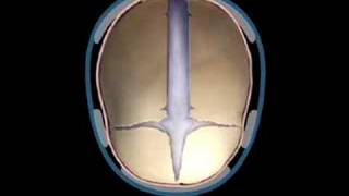 Sagittal Synostosis Helmet Therapy  Craniosynostosis Surgery [upl. by Novanod]