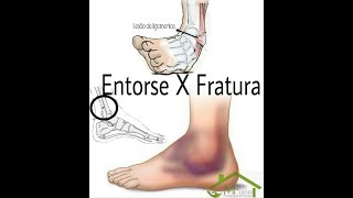 Entorse do Tornozelo com Fratura Luxação TRATAMENTO CONSERVADOR Clínica Fisioterapia Dr Robson Sitta [upl. by Joan664]