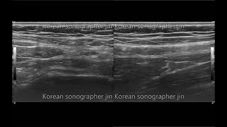 Practice2 Look for appendix  실습2 appendix 찾기 ultrasound sonography [upl. by Salome184]