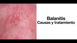 Balanitis Causas y tratamiento  Cura de la balanitis [upl. by Soilissav]