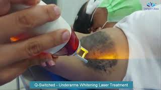 QSwitched Underarms Whitening Laser Treatment [upl. by Mabel]