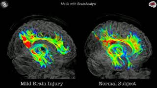 Tractographie TC versus Normal [upl. by Hube967]