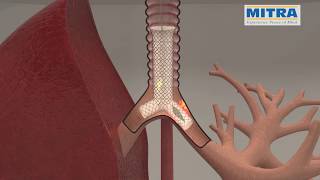 Tracheobronchial quotYquot stent MITRA OTTOMED ENDOSCOPY Interventional Pulmonology [upl. by Anna-Diana]