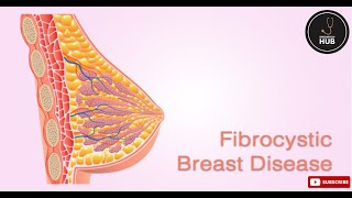 Fibrocystic Breast Disease Symptoms Causes amp Treatment Options  KnowHow Hub [upl. by Anaiuq]