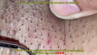 V58  for fun armpit blackheads kalkal relaxing satisfying hairremoval ingrownhair sleep [upl. by Mada871]