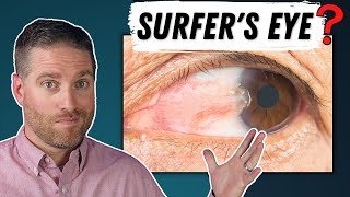 Surfers Eye  Pterygium Explained Growth On Your Eye [upl. by Feldman]