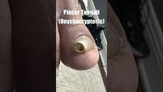 Pincer Toenail Onychocryptosis [upl. by Ycrad]