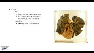 Large vein  Deep vein thrombosis Gross pathology [upl. by Anny222]