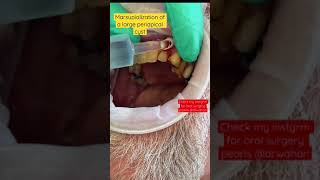 Marsupialization of a large radicular cyst [upl. by Kcaj350]