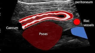 Appendicitis Ultrasound [upl. by Egni73]