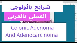 Colon histology  colonic adenocarcinoma  Tubulovillous adenoma low grade and high grade [upl. by Ecerehs]