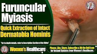 Furuncular Myiasis  Quick Extraction of Intact Dermatobia Hominis  Womens Healthcare [upl. by Jane565]