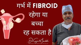 गर्भ में Fibroid रहेगा या बच्चा रह सकता हैDrSunil JindalJINDAL HOSPITALMEERUT [upl. by Nevi]