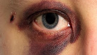 How to Get Rid of a Black Eye in 30 Minutes [upl. by Sinnelg]