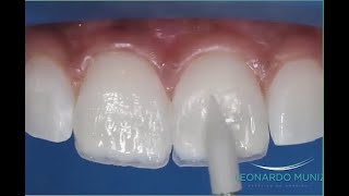 Alargamiento incisal con resinas compuestas [upl. by Randy727]