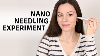 NanoNeedling for 3 Weeks with Deminuage amp the Ordinary Serum Before amp Afters [upl. by Llertac962]