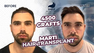 Transformative Hair Transplant Journey  12 Months Before amp After  4500 Grafts [upl. by Ainehta]