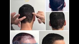 Trapianto capelli Micro FUE HD post FUT [upl. by Adekan]