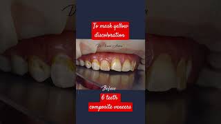 How to fix dental fluorosisFluorosis stains removalVeneer [upl. by Latrina]